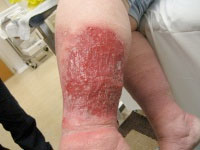 Patient with lymphedema and wound