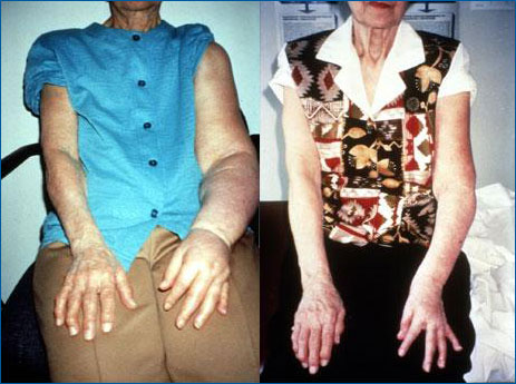 Upper Extremity Lymphedema; before and after treatment.