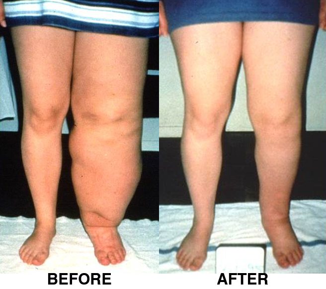 Lower extremity lymphedema before and after CDT